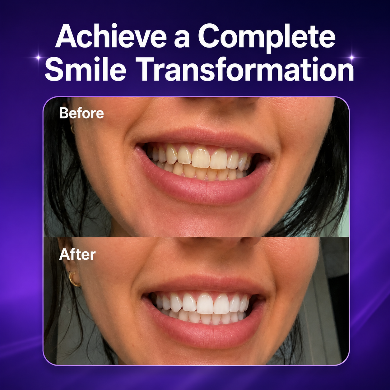 🔥HOT SALE🔥 Purple Teeth Whitening Strips